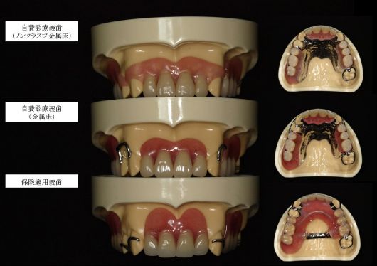 有床義歯説明用 – 【公式】広島市の歯科技工所「株式会社アート 