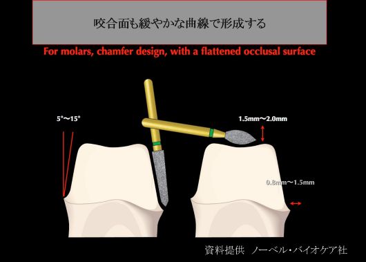 CAD/CAM 支台歯形成のポイント – 【公式】広島市の歯科技工所「株式 